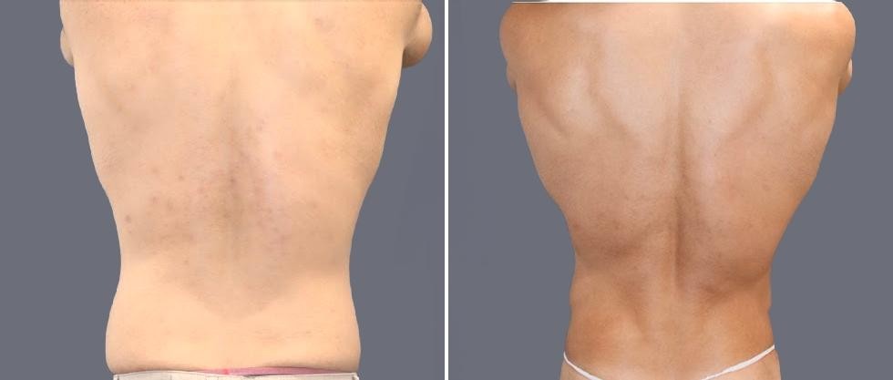Vaser Back Liposcution Male Pre2024 019 Before And After
