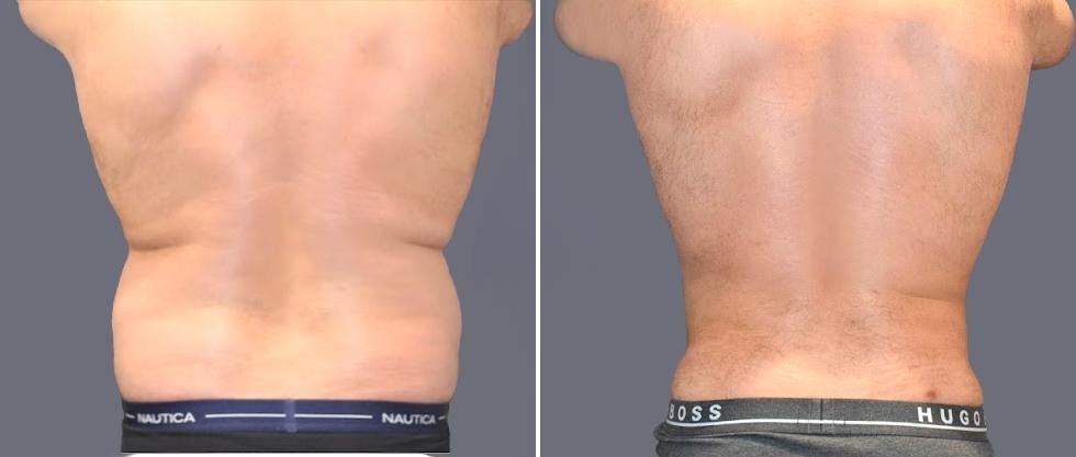 Vaser Back Liposcution Male Pre2024 020 Before And After