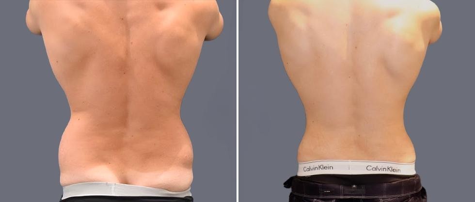 Vaser Back Liposcution Male Pre2024 021 Before And After