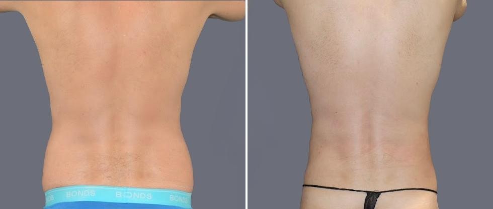 Vaser Back Liposcution Male Pre2024 022 Before And After