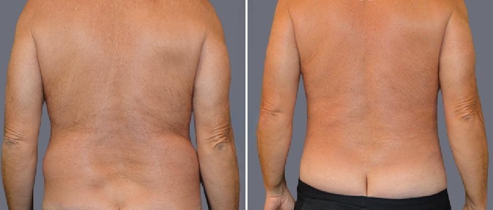 Vaser Back Liposcution Male Pre2024 023 Before And After