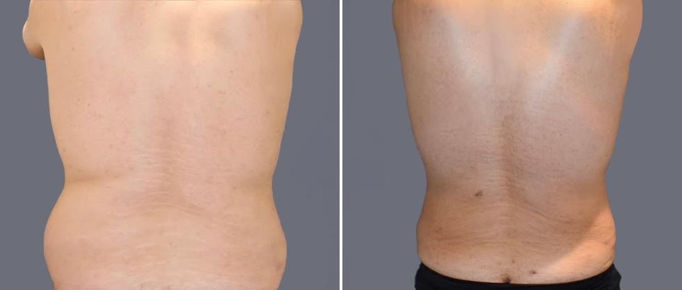 Vaser Back Liposcution Male Pre2024 024 Before And After