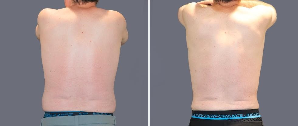 Vaser Back Liposcution Male Pre2024 025 Before And After