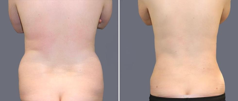Vaser Back Liposcution Male Pre2024 026 Before And After
