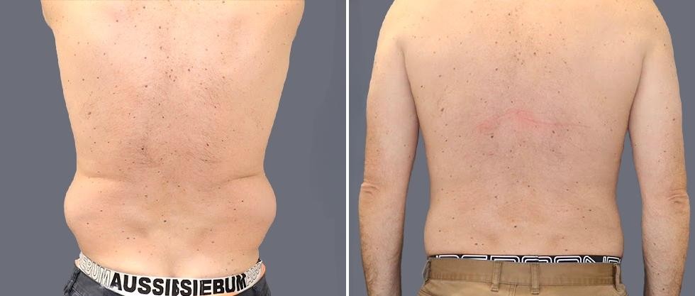 Vaser Back Liposcution Male Pre2024 027 Before And After