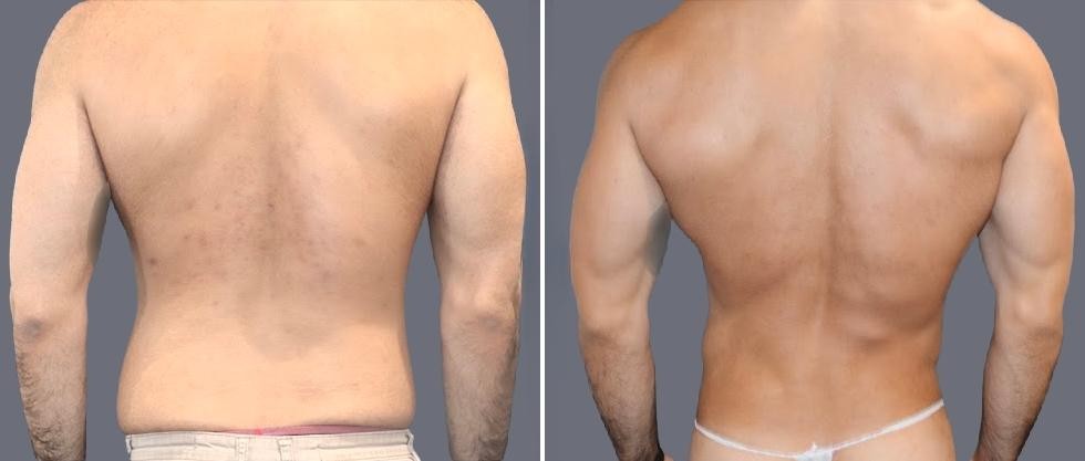 Vaser Back Liposcution Male Pre2024 028 Before And After