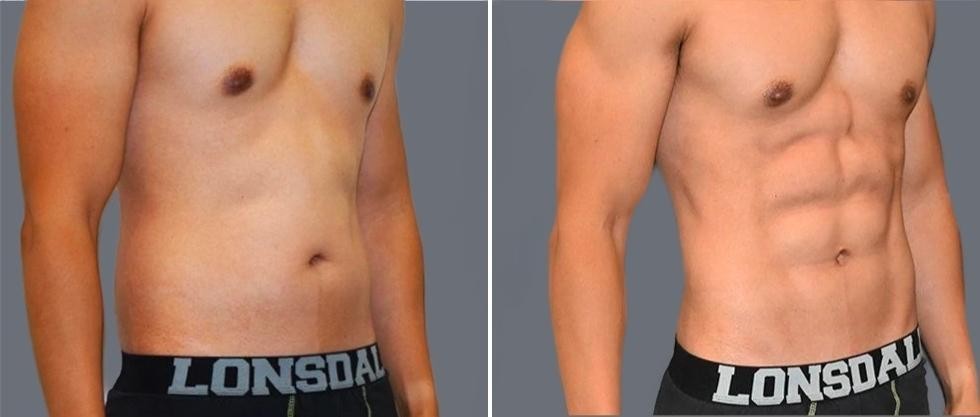 Vaser Hi Definition Pre2024 001 Before And After