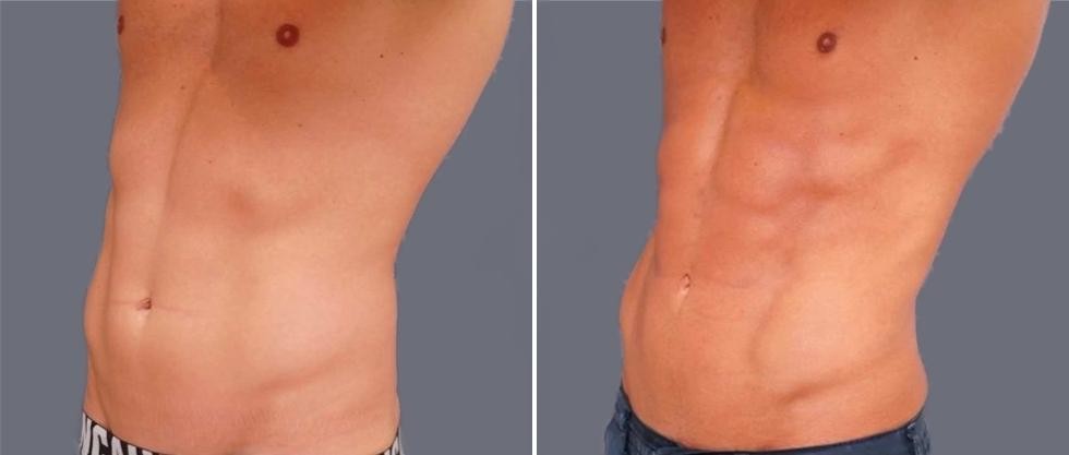 Vaser Hi Definition Pre2024 002 Before And After