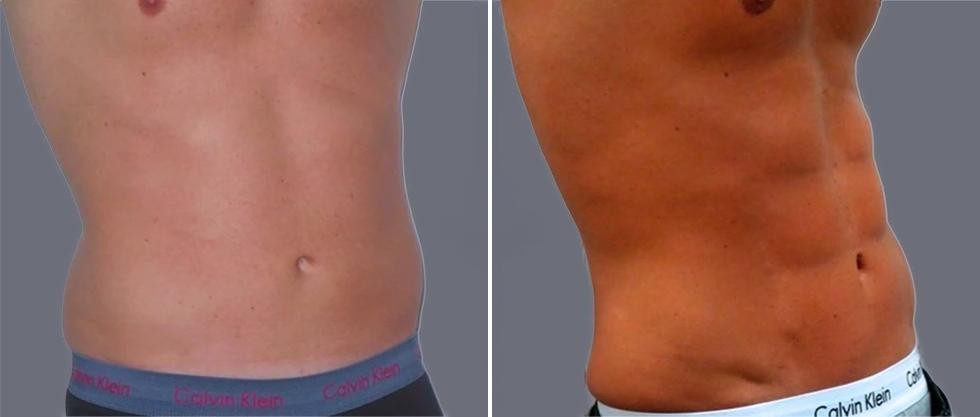 Vaser Hi Definition Pre2024 003 Before And After
