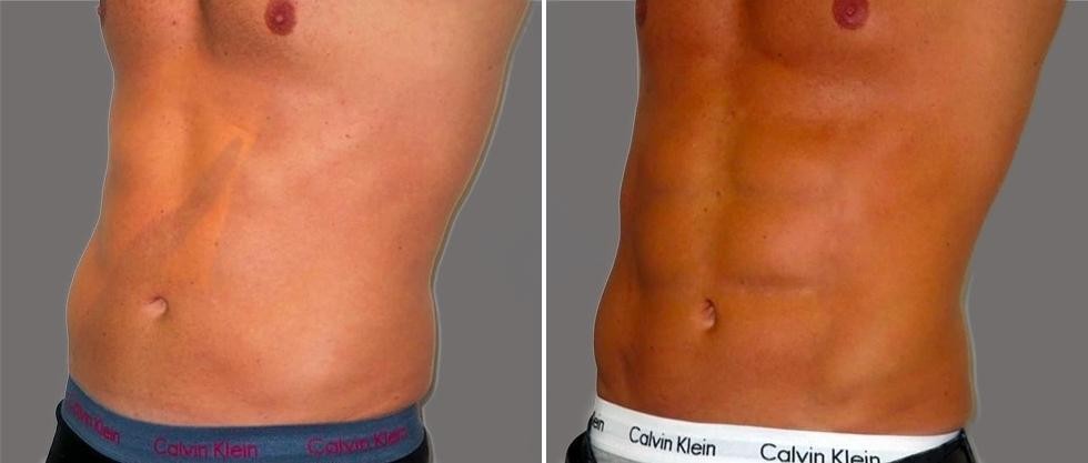 Vaser Hi Definition Pre2024 004 Before And After