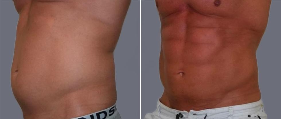Vaser Hi Definition Pre2024 005 Before And After