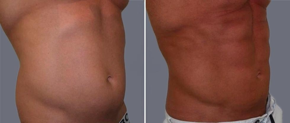 Vaser Hi Definition Pre2024 006 Before And After