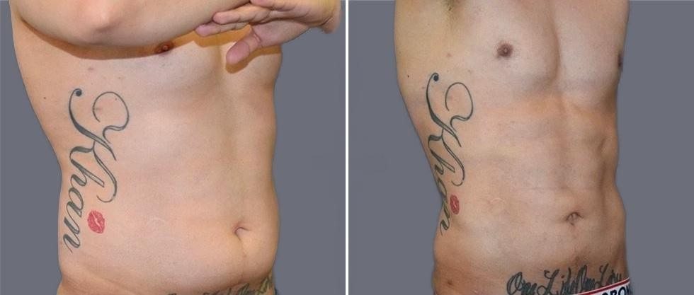 Vaser Hi Definition Pre2024 007 Before And After