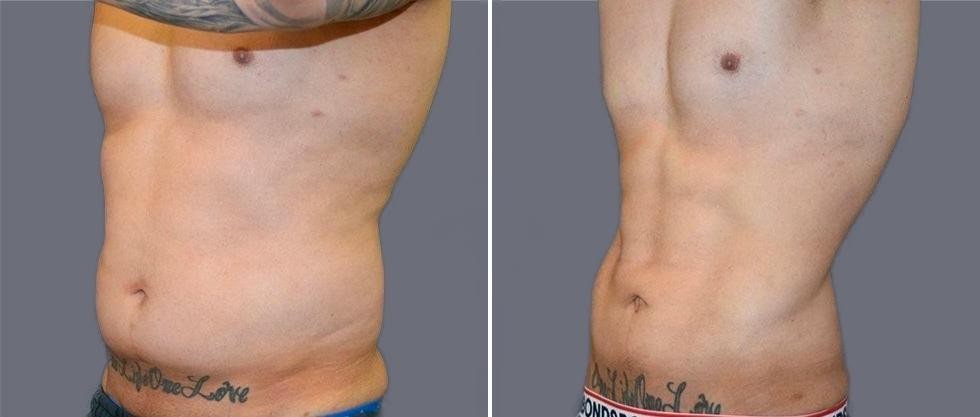 Vaser Hi Definition Pre2024 008 Before And After