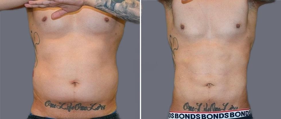 Vaser Hi Definition Pre2024 009 Before And After