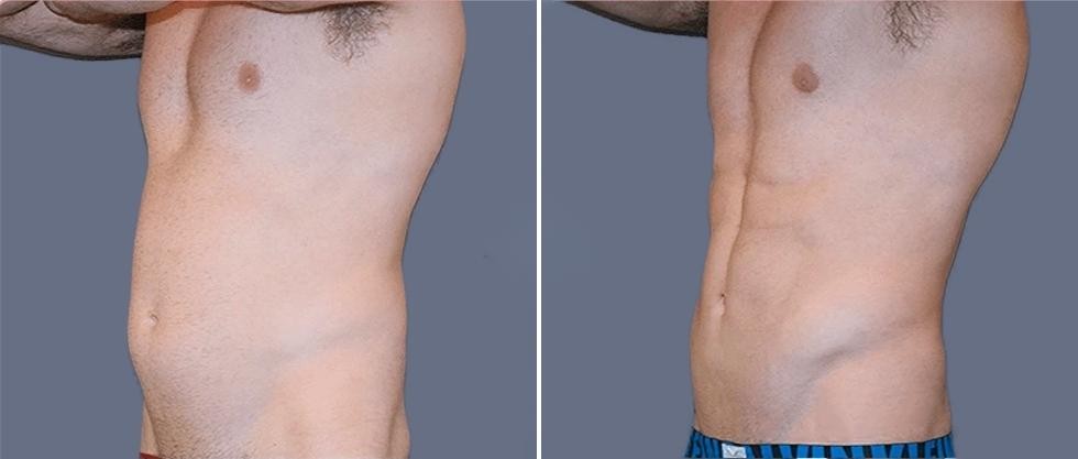 Vaser Hi Definition Pre2024 010 Before And After