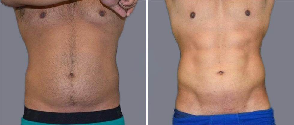 Vaser Hi Definition Pre2024 011 Before And After