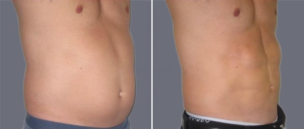 Vaser Hi Definition Pre2024 012 Before And After