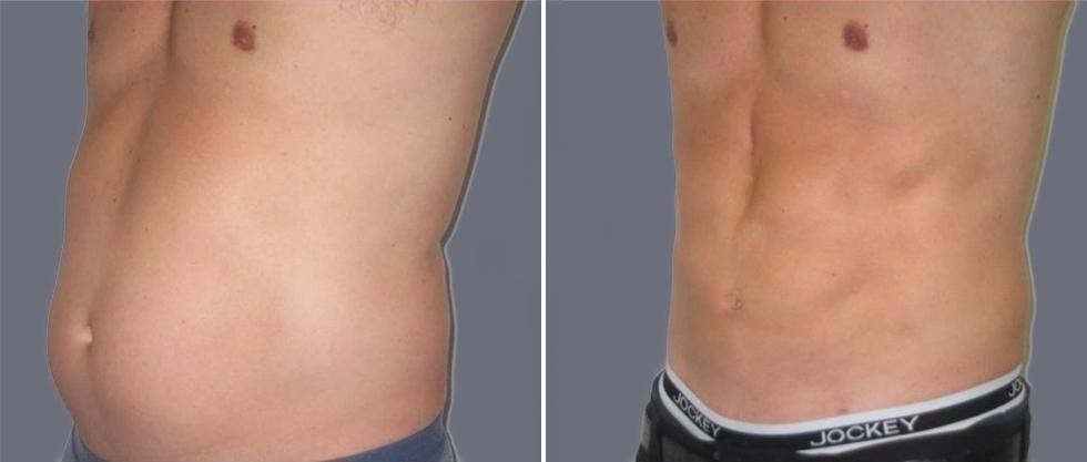 Vaser Hi Definition Pre2024 013 Before And After
