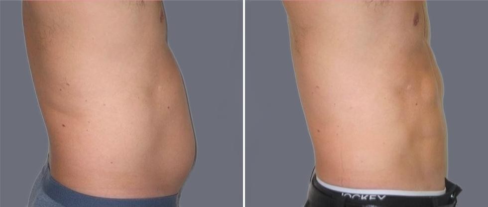Vaser Hi Definition Pre2024 014 Before And After