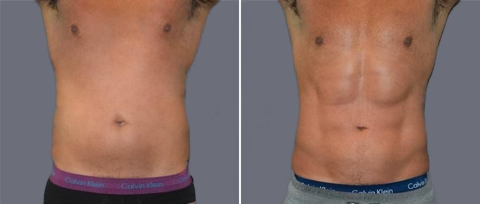 Vaser Hi Definition Pre2024 015 Before And After