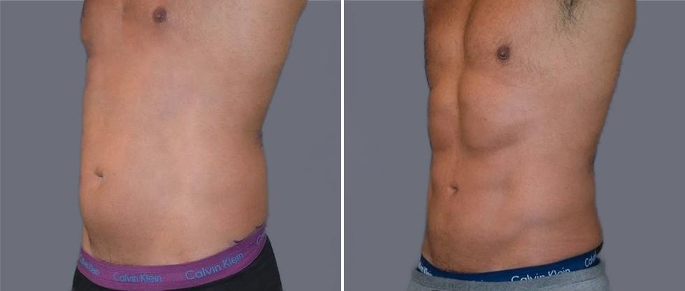 Vaser Hi Definition Pre2024 016 Before And After