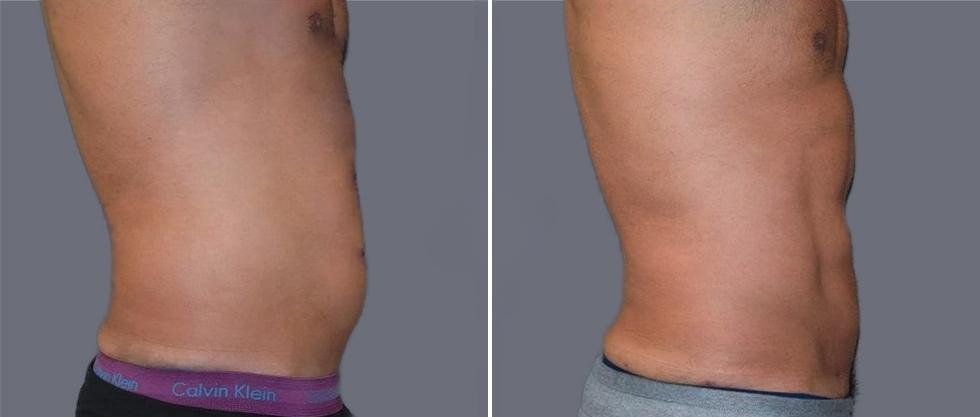 Vaser Hi Definition Pre2024 017 Before And After