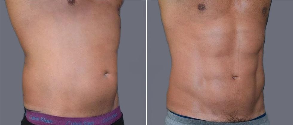 Vaser Hi Definition Pre2024 018 Before And After