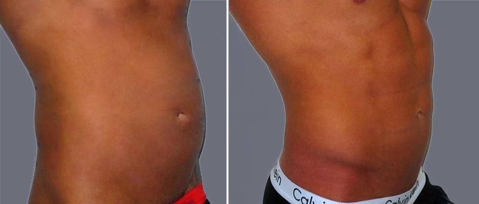 Vaser Hi Definition Pre2024 019 Before And After