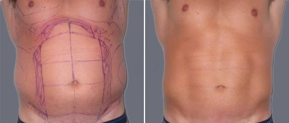 Vaser Hi Definition Pre2024 020 Before And After