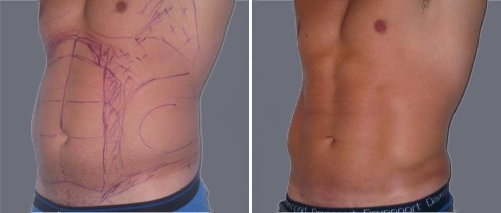 Vaser Hi Definition Pre2024 021 Before And After