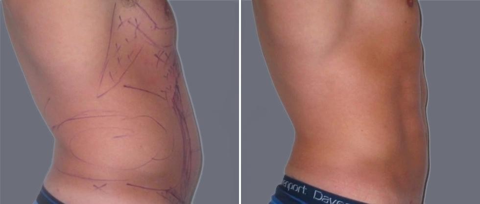 Vaser Hi Definition Pre2024 022 Before And After