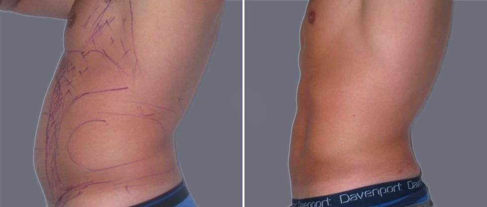 Vaser Hi Definition Pre2024 023 Before And After