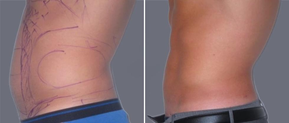 Vaser Hi Definition Pre2024 024 Before And After