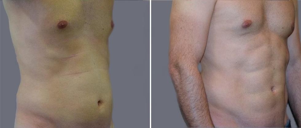 Vaser Hi Definition Pre2024 025 Before And After