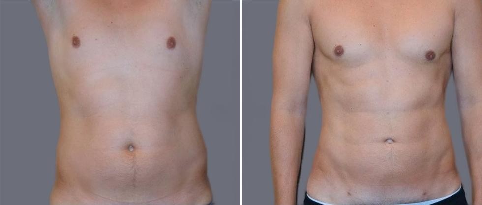 Vaser Hi Definition Pre2024 026 Before And After