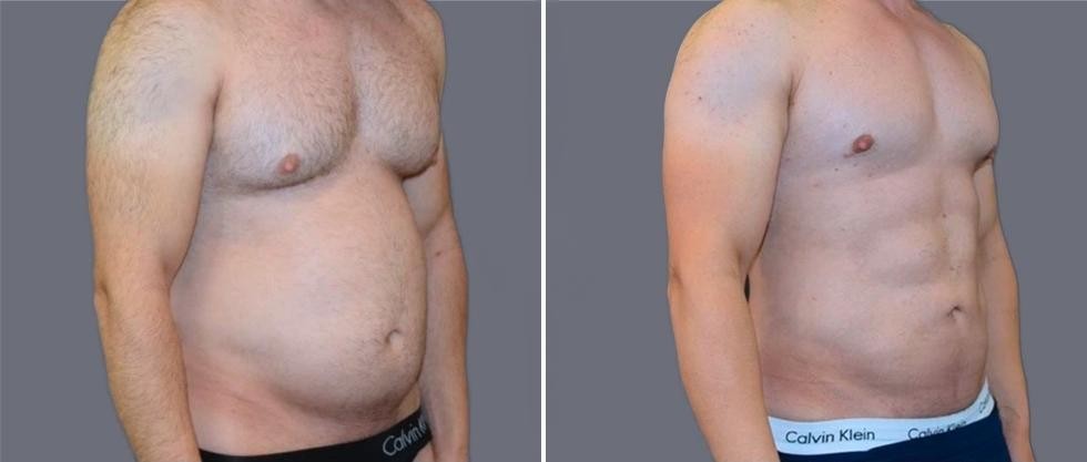 Vaser Hi Definition Pre2024 027 Before And After