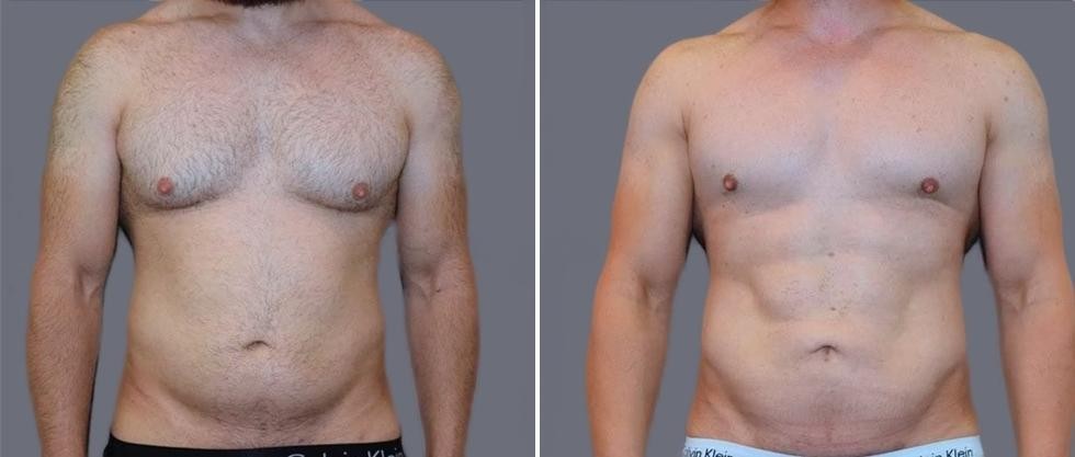 Vaser Hi Definition Pre2024 028 Before And After