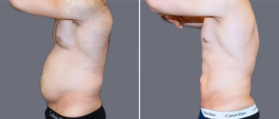 Vaser Hi Definition Pre2024 029 Before And After