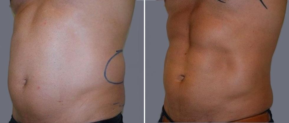 Vaser Hi Definition Pre2024 030 Before And After