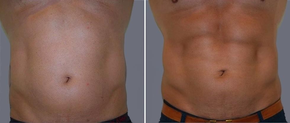 Vaser Hi Definition Pre2024 031 Before And After