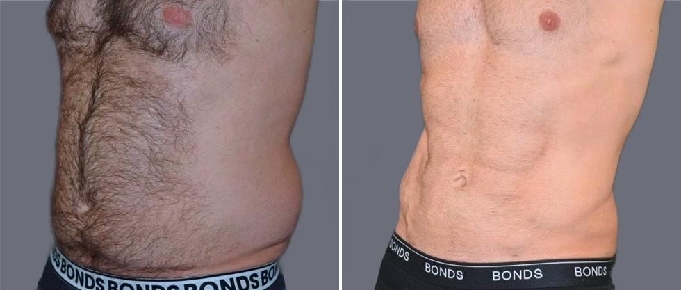 Vaser Hi Definition Pre2024 032 Before And After