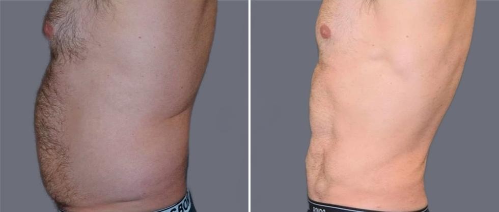 Vaser Hi Definition Pre2024 033 Before And After