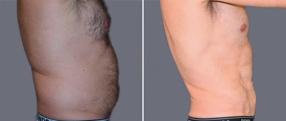 Vaser Hi Definition Pre2024 034 Before And After