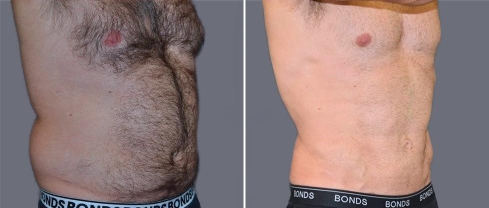 Vaser Hi Definition Pre2024 035 Before And After