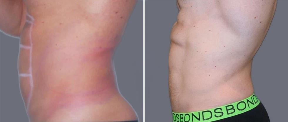 Vaser Hi Definition Pre2024 036 Before And After