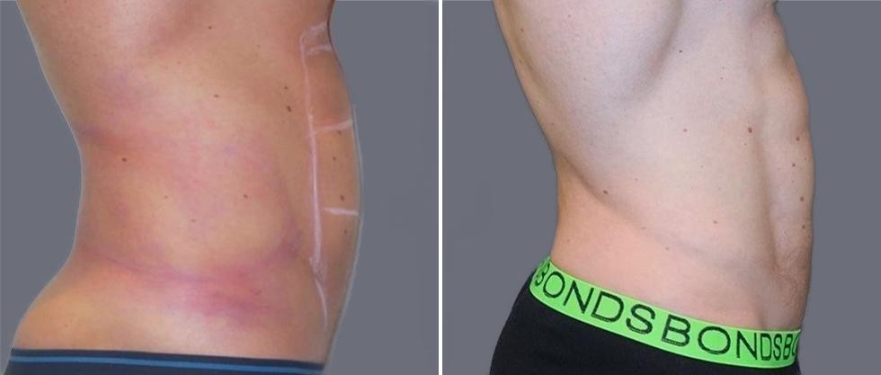 Vaser Hi Definition Pre2024 037 Before And After