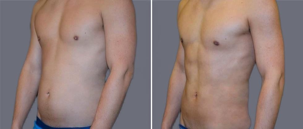 Vaser Hi Definition Pre2024 038 Before And After