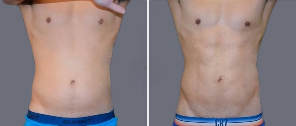 Vaser Hi Definition Pre2024 039 Before And After
