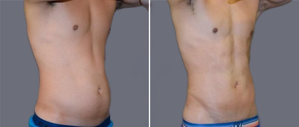 Vaser Hi Definition Pre2024 040 Before And After